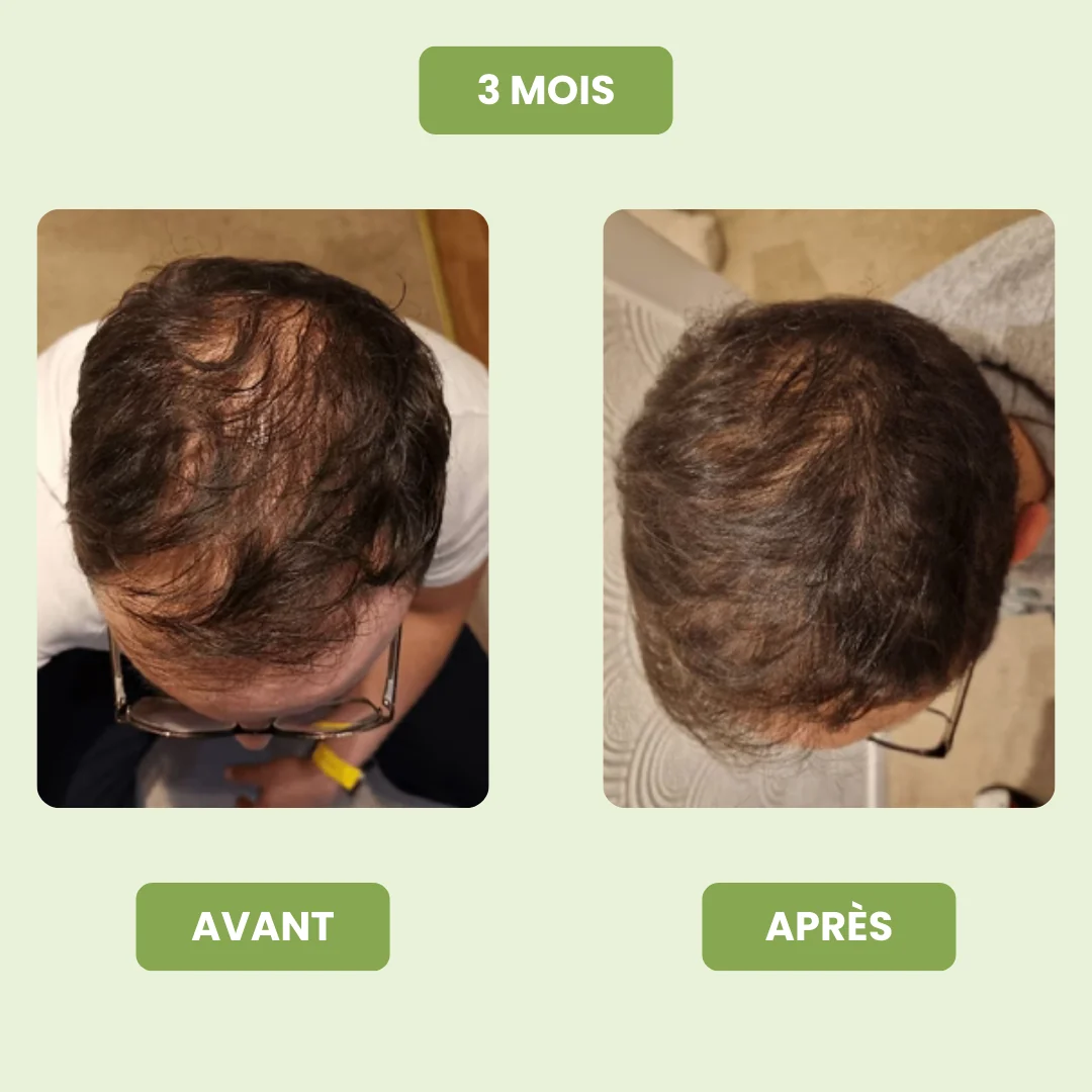 Sérum de Croissance Capillaire pour Hommes